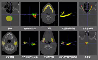 從頭頸部癌癥靶區(qū)勾畫入手,「邃藍智能」認為AI能解決的醫(yī)療痛點還有很多